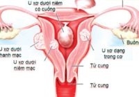 17. U xơ tử cung có nguy cơ chuyển thành ung thư không - Hình 2